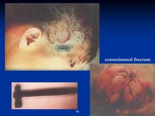 69
comminuted fracture
 
