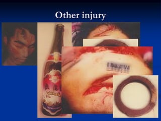 Other injury
72
 