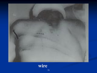 wire
73
 