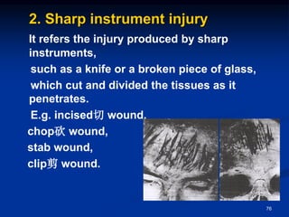 2. Sharp instrument injury
It refers the injury produced by sharp
instruments,
such as a knife or a broken piece of glass,
which cut and divided the tissues as it
penetrates.
E.g. incised切 wound,
chop砍 wound,
stab wound,
clip剪 wound.
76
 