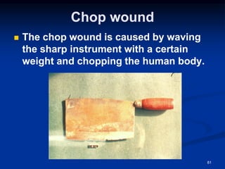 Chop wound
◼ The chop wound is caused by waving
the sharp instrument with a certain
weight and chopping the human body.
81
 
