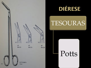 DIÉRESE
TESOURAS
Potts
 