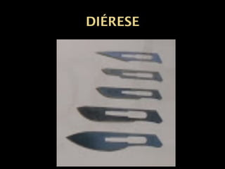 DIÉRESE
 