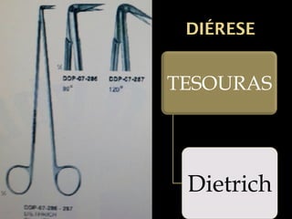 Diérese
Em 1883 quando um grande ciclone
passou por Rochester, o Dr. William Mayo
chefiou um hospital improvisado para
socorrer as vítimas. Sua eficiência foi tanta
que levou à fundação do St. Mary’s
Hospital, assim nascia a famosa Clínica
Mayo. Além da Clínica Mayo, há uma
infinidade de contribuições à cirurgia, tais
como: a sua famosa tesoura cirúrgica.
 