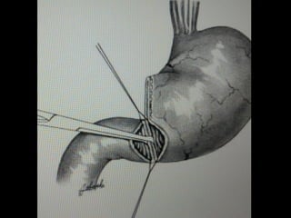 PREENSÃO
PINÇAS ELÁSTICAS
•Com ou sem dentes nas pontas
•Anatômica
•Cushing
•Dente de rato
•Adson
 
