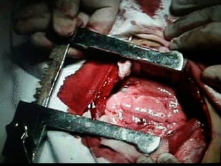 PREENSÃO
Babcock
– menor
lesão
tissular
 