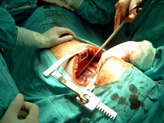 PREENSÃO
Cheron
– anti-
sepsia
 