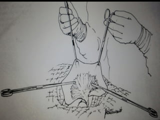 AFASTADORES
WEITLANER - hérnias
 