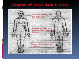 Diagram of Body: Back & Front Periorbital swelling and face puffiness Distended abdomen with positive shifting dullness and fluid thrills Bilateral pitting oedema up to mid shin 