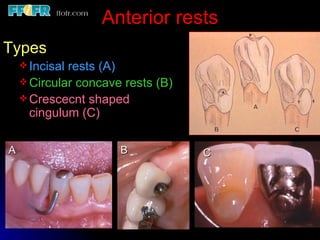 3.partial denture rests | PPT