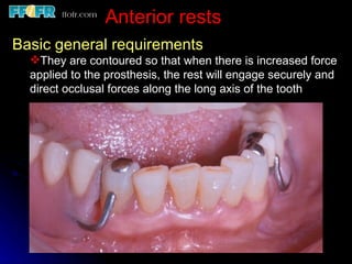 3.partial denture rests | PPT