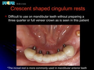 3.partial denture rests | PPT