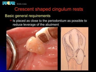 3.partial denture rests | PPT