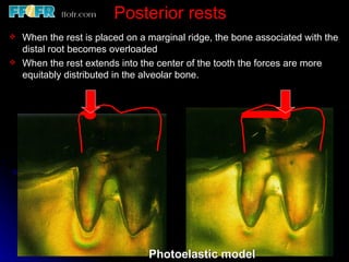 3.partial denture rests | PPT