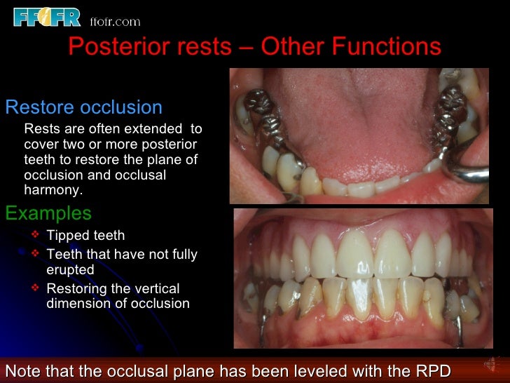 3.partial denture rests