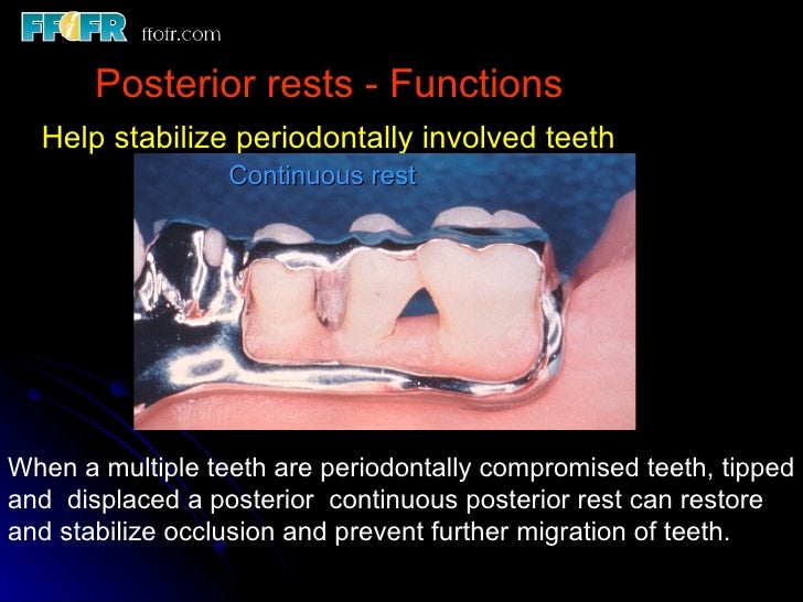3.partial denture rests