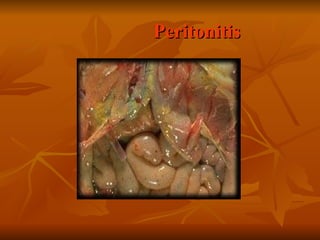 Peritonitis 