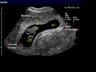 D SG E VV Saco  Gestacional Decídua Embrião Vesícula  Vitelina 