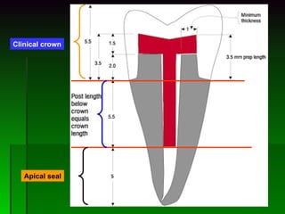 Clinical crown Apical seal 