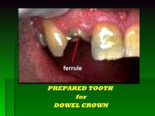 PREPARED TOOTH  for DOWEL CROWN ferrule 