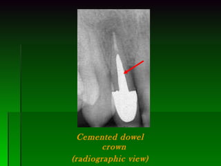 Cemented dowel crown (radiographic view) 