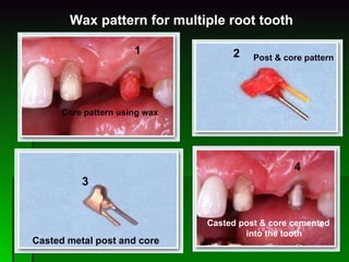 1 2 3 4 Casted metal post and core Post & core pattern Core pattern using wax Casted post & core cemented  into the tooth Wax pattern for multiple root tooth 