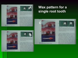 Wax pattern for a  single root tooth A B C 