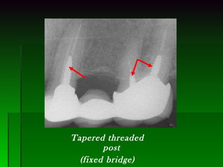 Tapered threaded post (fixed bridge) 