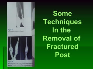 Some Techniques In the  Removal of  Fractured Post 