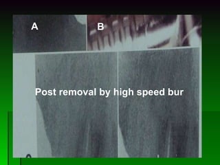 Post removal by high speed bur A B 
