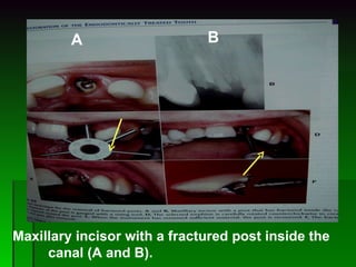 Maxillary incisor with a fractured post inside the  canal (A and B). A B 