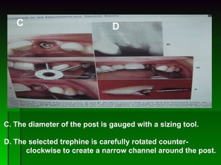 C. The diameter of the post is gauged with a sizing tool. D. The selected trephine is carefully rotated counter- clockwise to create a narrow channel around the post. C D 