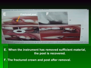 E.  When the instrument has removed sufficient material,  the post is recovered. F. The fractured crown and post after removal. F E Fractured post 
