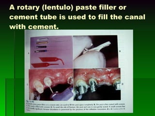 A rotary (lentulo) paste filler or cement tube is used to fill the canal with cement. 