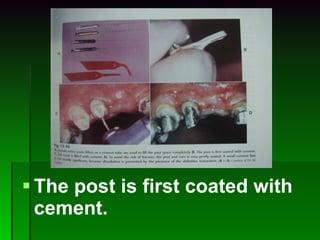 The post is first coated with cement. 