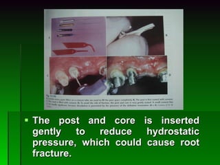 The post and core is inserted gently to reduce hydrostatic pressure, which could cause root fracture. 