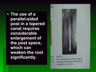 The use of a parallel-sided post in a tapered canal requires considerable enlargement of the post space, which can weaken the root significantly. 