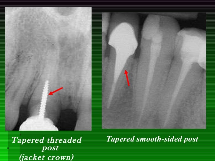 3. post retained crownmidterm3