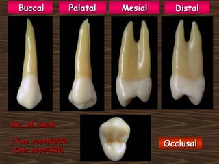DistalDistalMesialMesialPalatalPalatal
OcclusalOcclusal
BuccalBuccal
No. of rootsNo. of roots
Two roots(60%Two roots(60%(.(.
One root(40%One root(40%(.(.
 