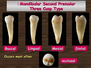 BuccalBuccal LingualLingual MesialMesial
occlusalocclusal
DistalDistal
Mandibular Second PremolarMandibular Second Premolar::
Three Cusp TypeThree Cusp Type
Occurs most oftenOccurs most often
 