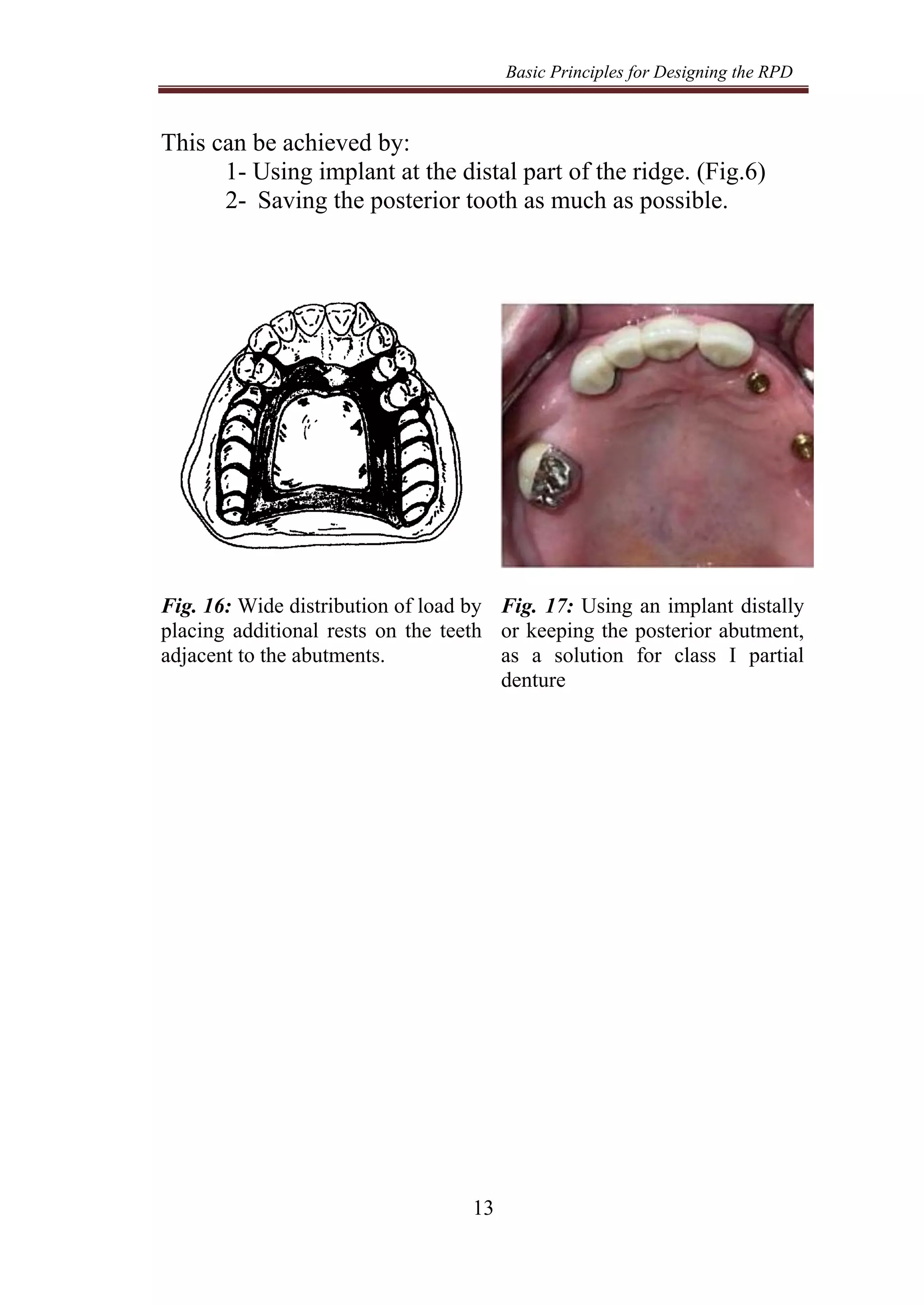 Basic Principles for Designing the RPD
13
This can be achieved by:
1- Using implant at the distal part of the ridge. (Fig.6)
2- Saving the posterior tooth as much as possible.
Fig. 16: Wide distribution of load by
placing additional rests on the teeth
adjacent to the abutments.
Fig. 17: Using an implant distally
or keeping the posterior abutment,
as a solution for class I partial
denture
 