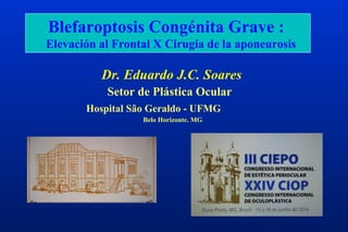 Blefaroptosis Congénita Grave :
Elevación al Frontal X Cirugía de la aponeurosis
Belo Horizonte. MG
Dr. Eduardo J.C. Soares
Hospital São Geraldo - UFMG
Setor de Plástica Ocular
 