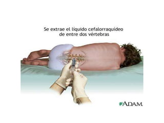 3 punció lumbar