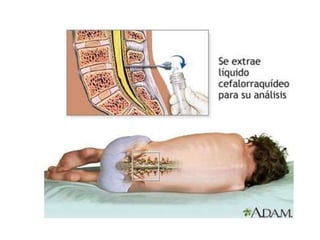 3 punció lumbar