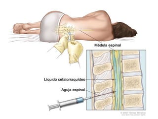 3 punció lumbar