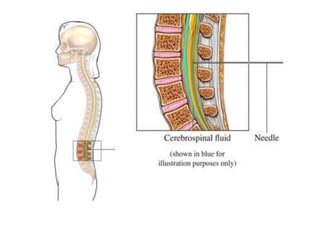 3 punció lumbar