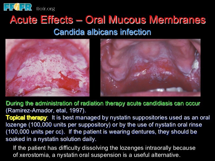 3.radiation effects mucosa, taste, jaw opening
