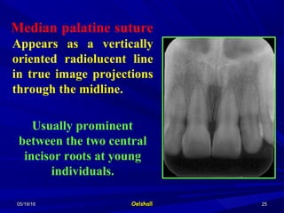 05/19/1605/19/16 OelshallOelshall 2525
Median palatine suture
Appears as a vertically
oriented radiolucent line
in true image projections
through the midline.
Usually prominent
between the two central
incisor roots at young
individuals.
 