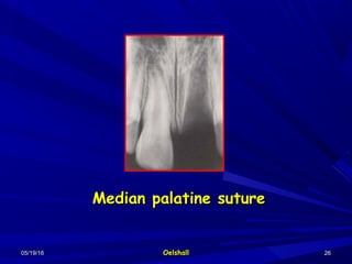 05/19/1605/19/16 OelshallOelshall 2626
Median palatine sutureMedian palatine suture
 
