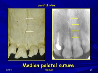 05/19/1605/19/16 OelshallOelshall 2727
Median palatal suture
palatal view
 